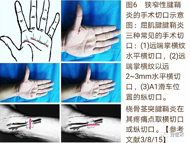 手腕部狭窄性腱鞘炎的诊治，一文掌握！