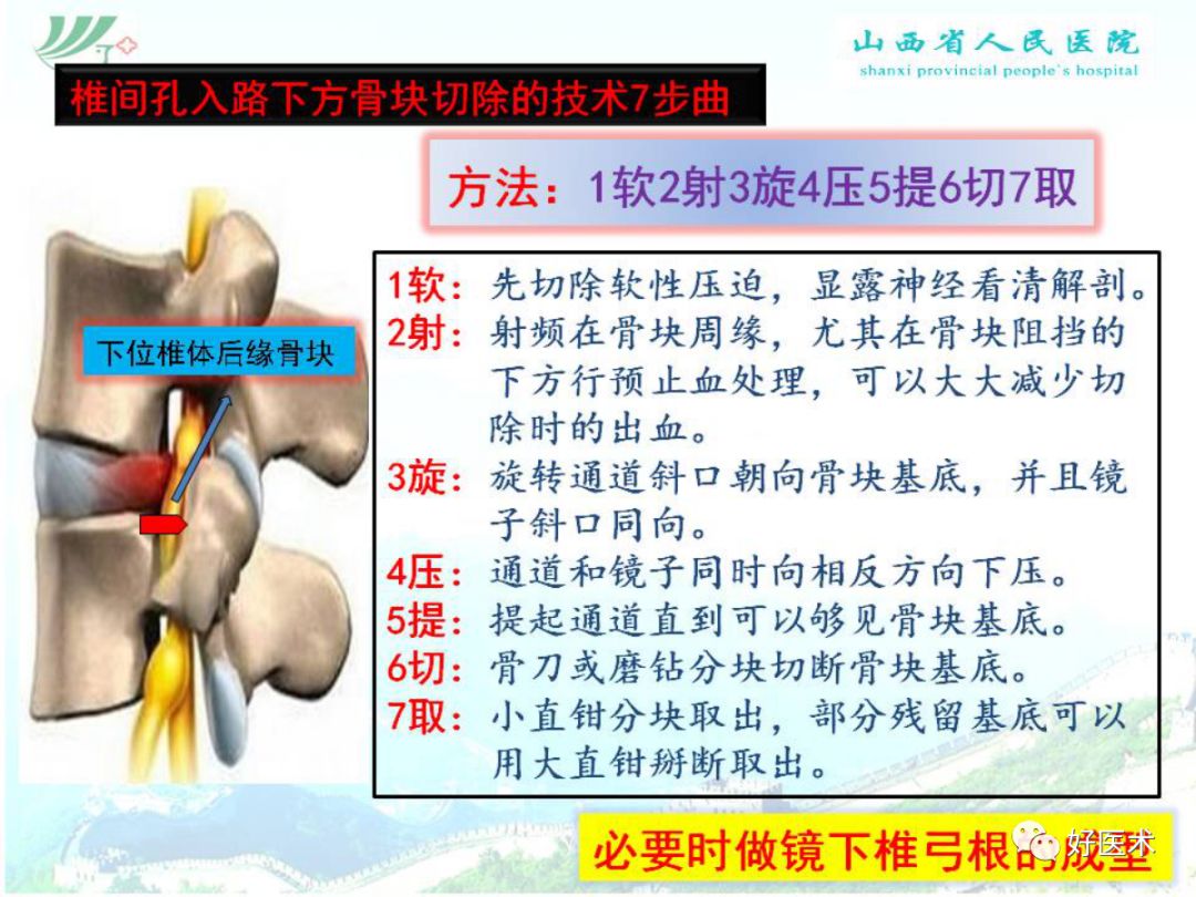 椎间孔镜治疗特殊类型腰椎间盘突出症，要点详解！