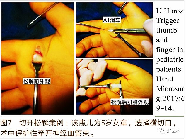 手腕部狭窄性腱鞘炎的诊治，一文掌握！