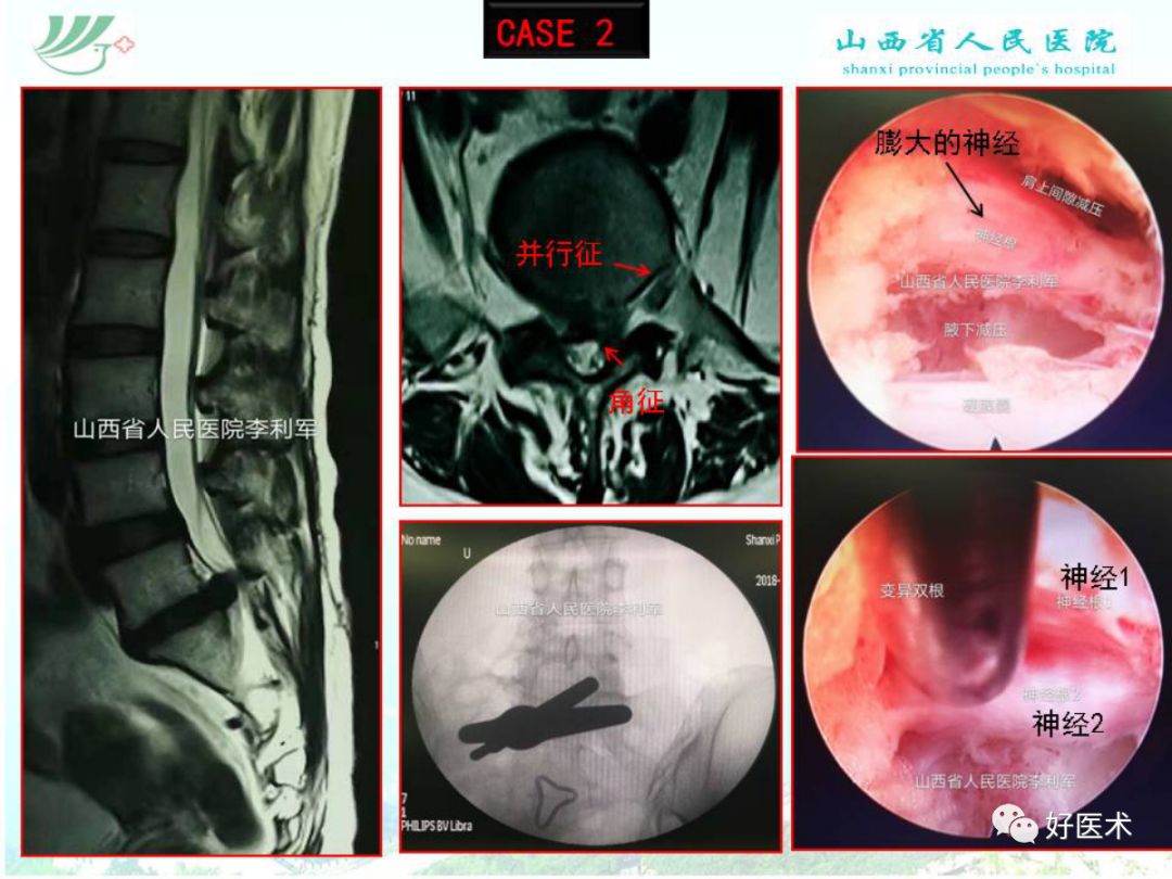 椎间孔镜治疗特殊类型腰椎间盘突出症，要点详解！