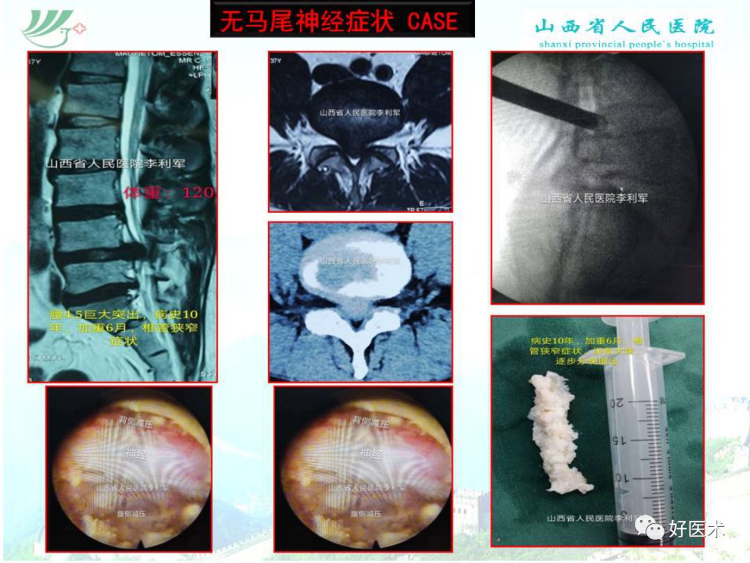 椎间孔镜治疗特殊类型腰椎间盘突出症，要点详解！