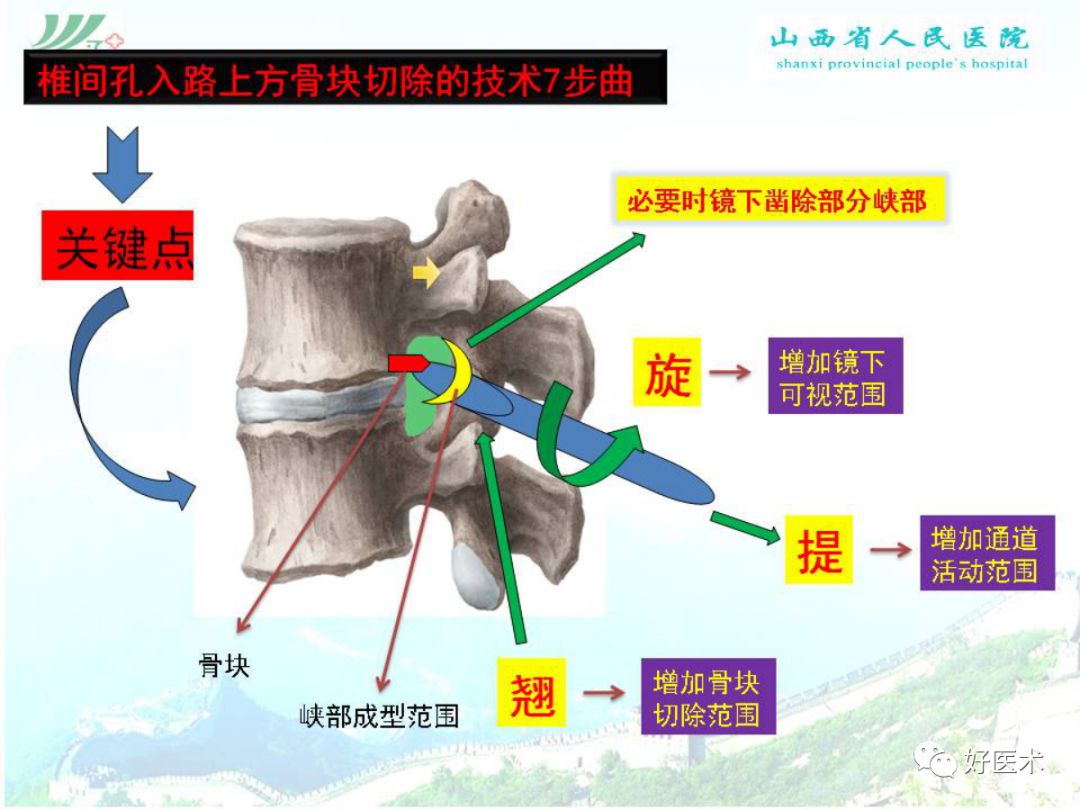 椎间孔镜治疗特殊类型腰椎间盘突出症，要点详解！