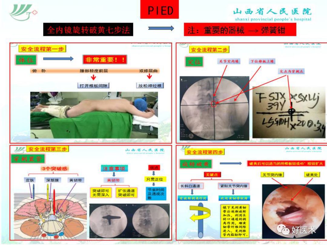 椎间孔镜治疗特殊类型腰椎间盘突出症，要点详解！