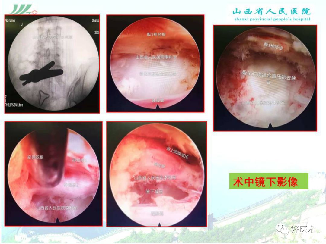 椎间孔镜治疗特殊类型腰椎间盘突出症，要点详解！