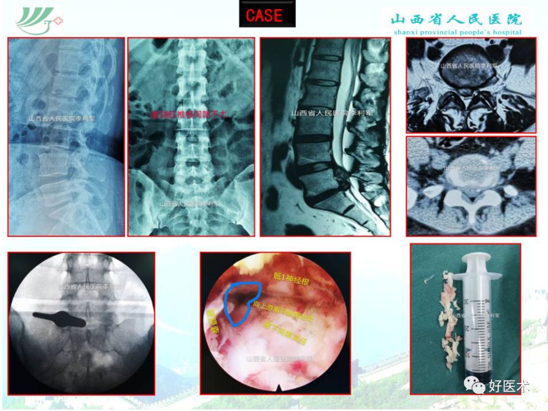 椎间孔镜治疗特殊类型腰椎间盘突出症，要点详解！