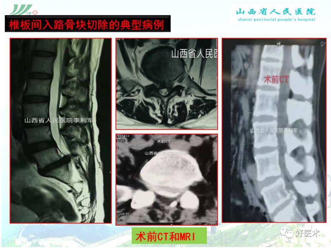 椎间孔镜治疗特殊类型腰椎间盘突出症，要点详解！