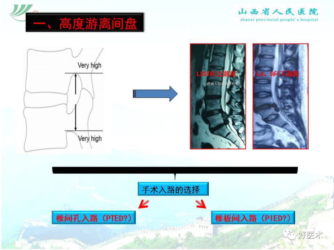 椎间孔镜治疗特殊类型腰椎间盘突出症，要点详解！