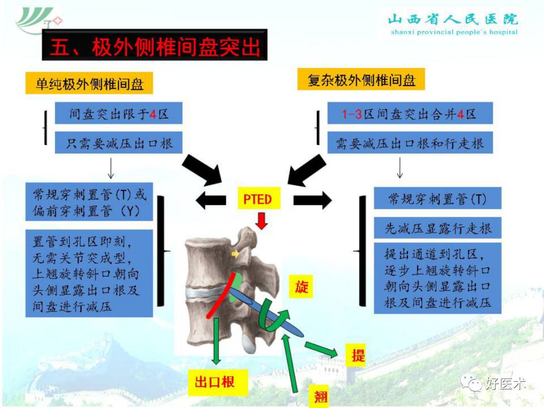 椎间孔镜治疗特殊类型腰椎间盘突出症，要点详解！