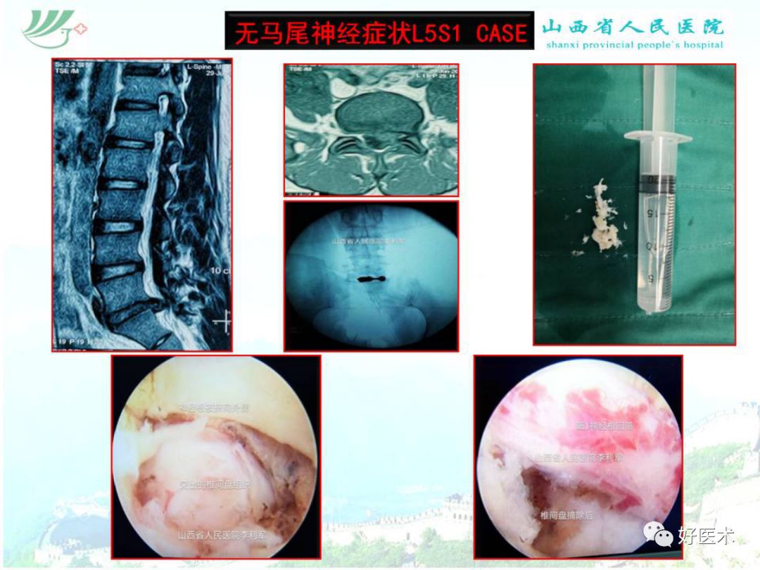 椎间孔镜治疗特殊类型腰椎间盘突出症，要点详解！