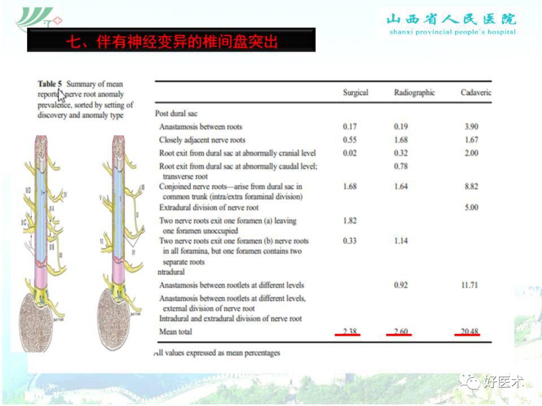 椎间孔镜治疗特殊类型腰椎间盘突出症，要点详解！