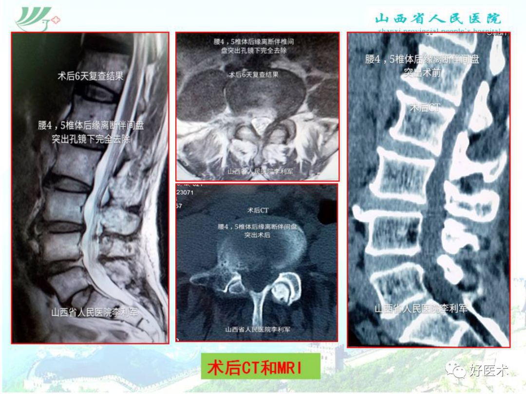 椎间孔镜治疗特殊类型腰椎间盘突出症，要点详解！