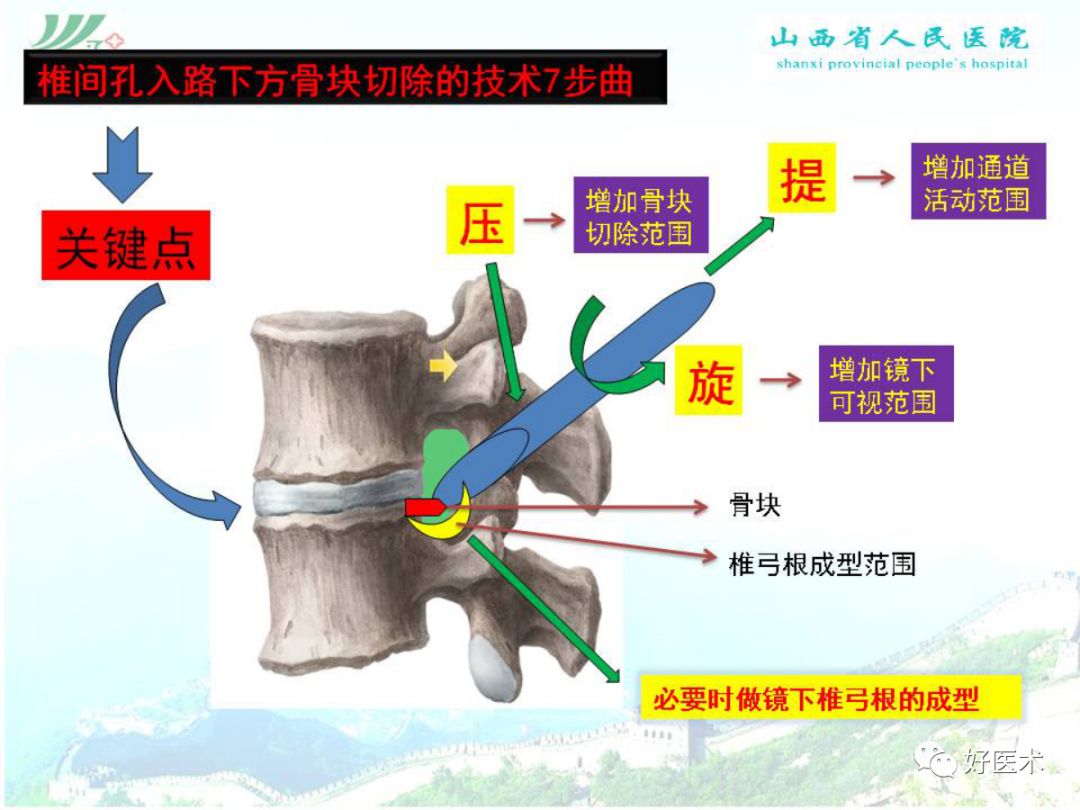 椎间孔镜治疗特殊类型腰椎间盘突出症，要点详解！