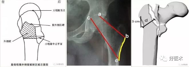 转子间骨折外侧壁不完整，如何处理？