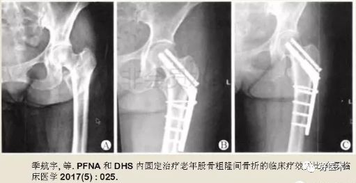 转子间骨折外侧壁不完整，如何处理？