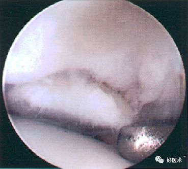 8分钟带您系统学习：髌骨软化症诊治要点！