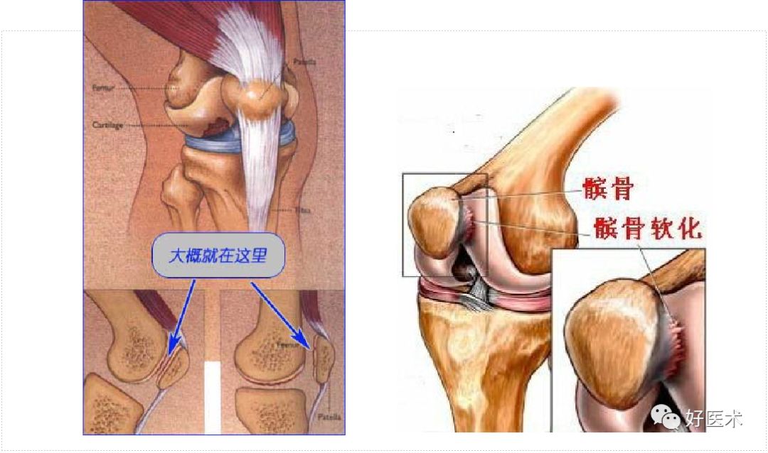 8分钟带您系统学习：髌骨软化症诊治要点！