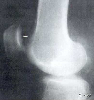 8分钟带您系统学习:髌骨软化症诊治要点!