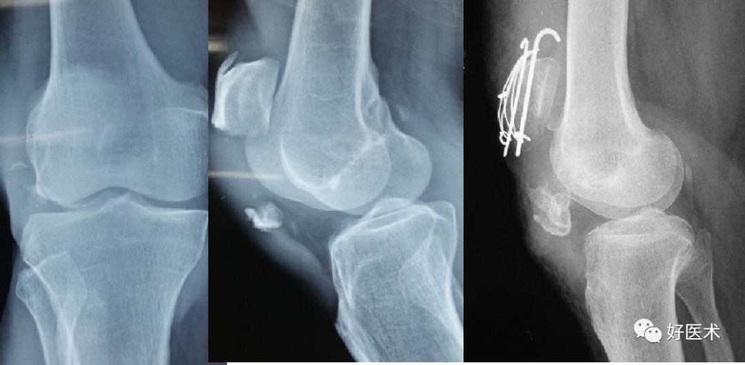 髌骨骨折的诊治要点，看这篇就够了！
