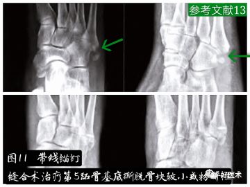 关于第五跖骨基底部骨折，你都掌握了吗？