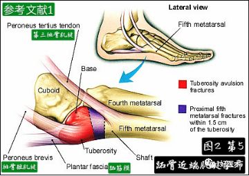 关于第五跖骨基底部骨折，你都掌握了吗？