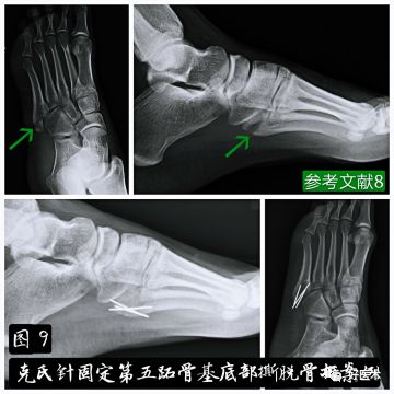 关于第五跖骨基底部骨折，你都掌握了吗？