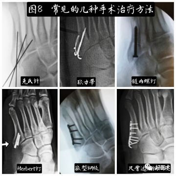 关于第五跖骨基底部骨折，你都掌握了吗？