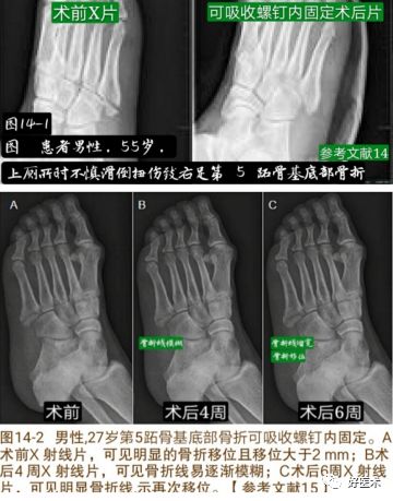 关于第五跖骨基底部骨折，你都掌握了吗？