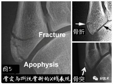 关于第五跖骨基底部骨折，你都掌握了吗？