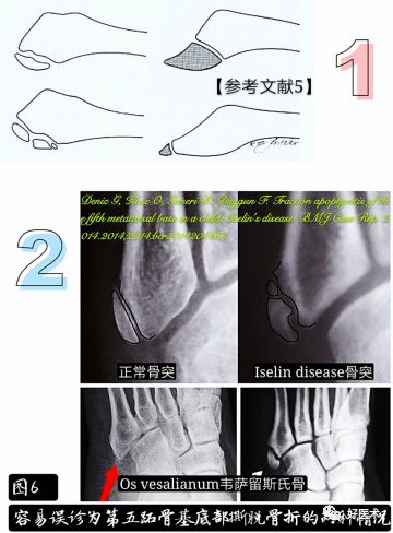 关于第五跖骨基底部骨折，你都掌握了吗？