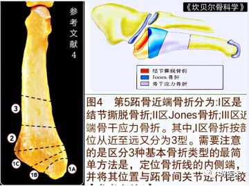 关于第五跖骨基底部骨折，你都掌握了吗？