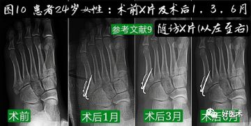 关于第五跖骨基底部骨折，你都掌握了吗？