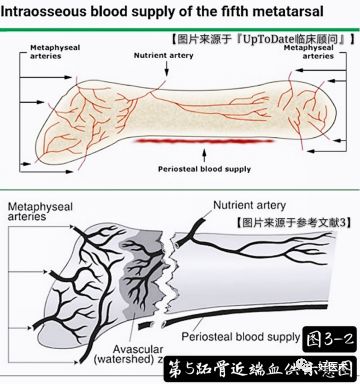 关于第五跖骨基底部骨折，你都掌握了吗？