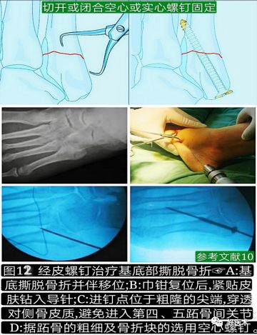 关于第五跖骨基底部骨折，你都掌握了吗？