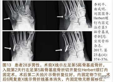 关于第五跖骨基底部骨折，你都掌握了吗？