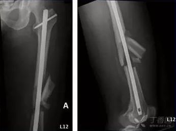 关于股骨干骨折，这5个常见问题你思考过吗？