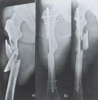 关于股骨干骨折，这5个常见问题你思考过吗？