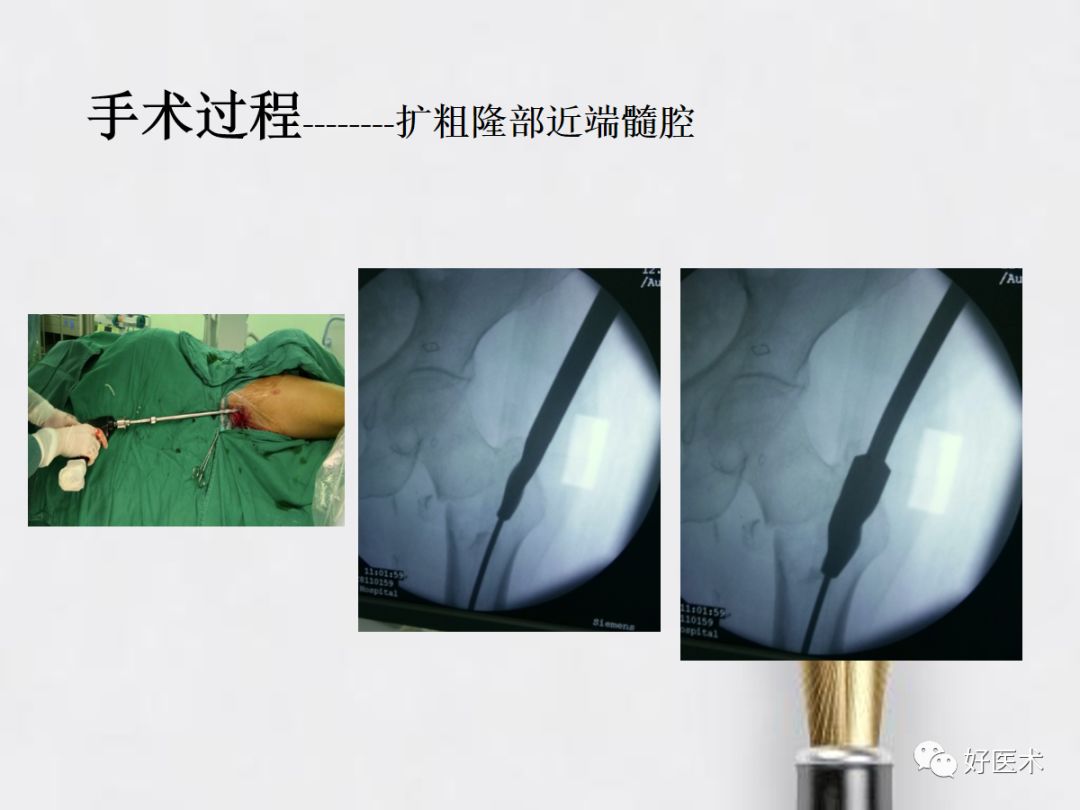 如何快速定位股骨髓内钉进针点？看这篇！