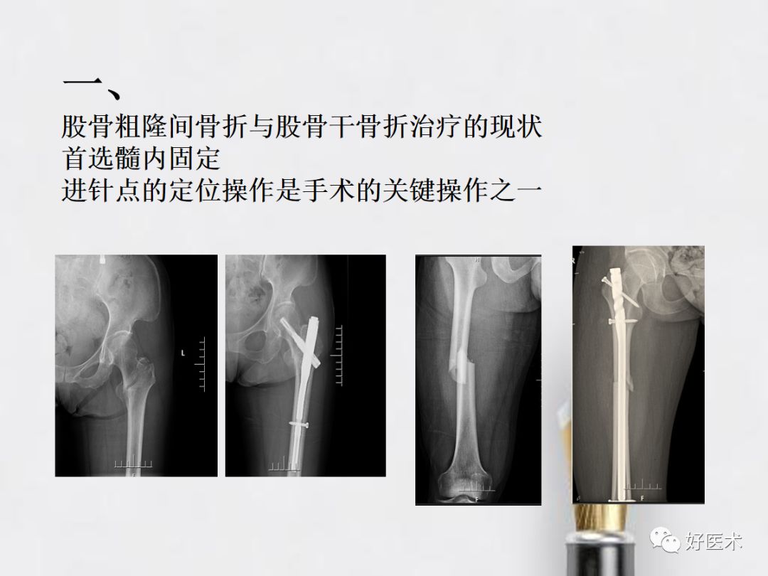 如何快速定位股骨髓内钉进针点？看这篇！