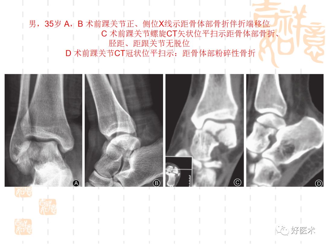 距骨骨折的手术入路及治疗技巧详解，值得一看！