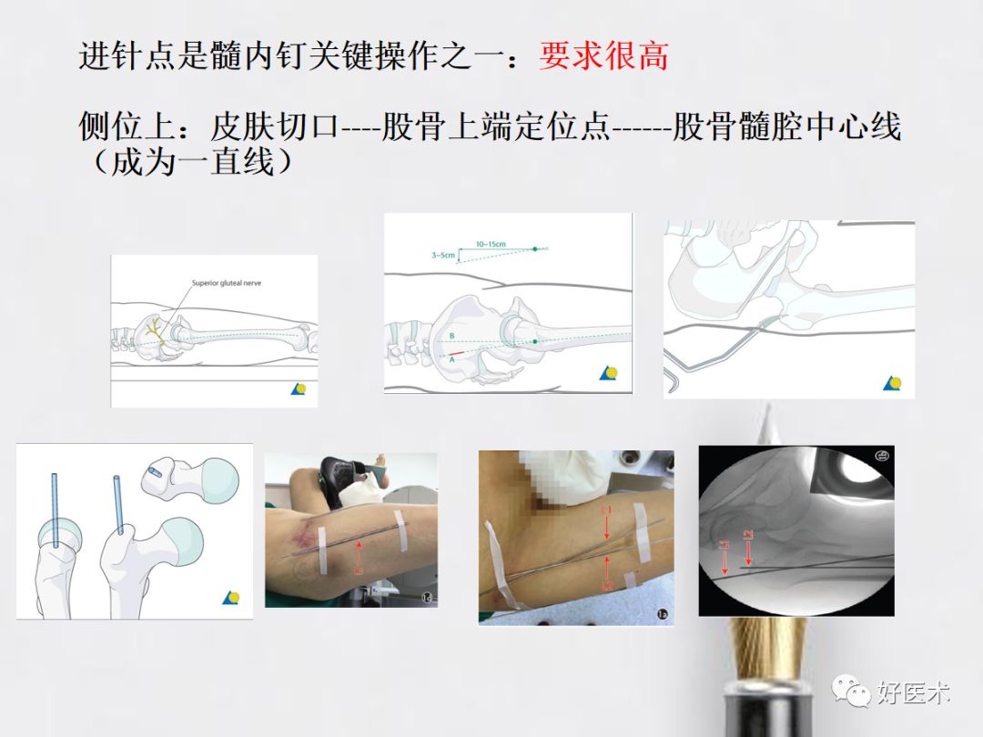 我院骨科完成首例股骨远端骨折闭合复位+倒打髓内钉内固定术 - 东胜区人民医院