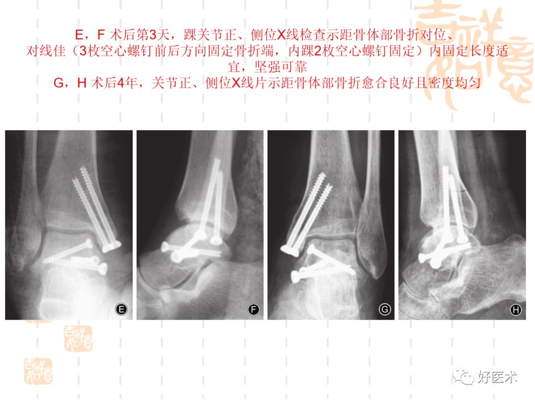 距骨骨折的手术入路及治疗技巧详解，值得一看！