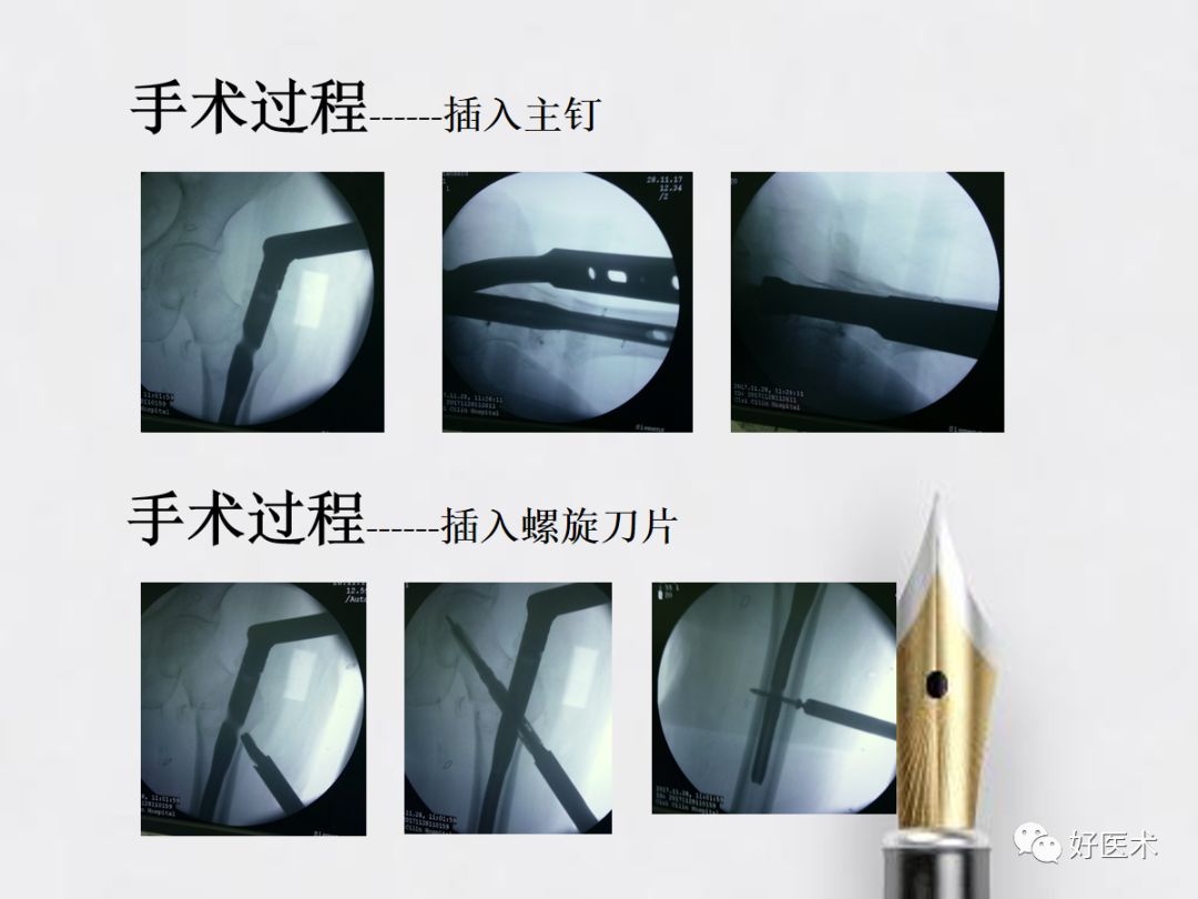 如何快速定位股骨髓内钉进针点？看这篇！