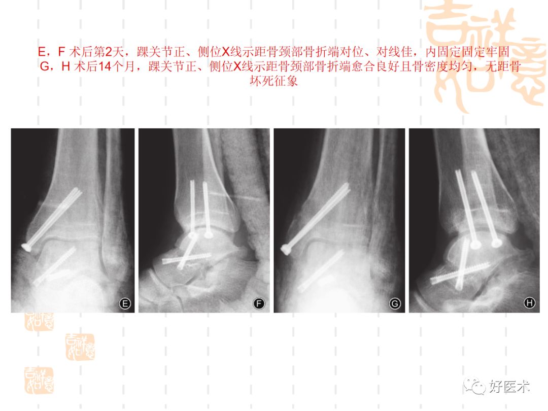 距骨骨折的手术入路及治疗技巧详解，值得一看！