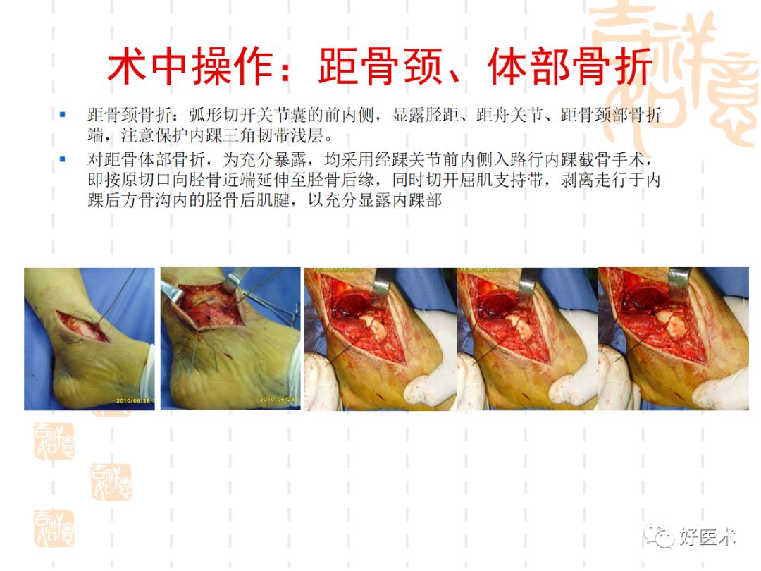 距骨骨折的手术入路及治疗技巧详解，值得一看！