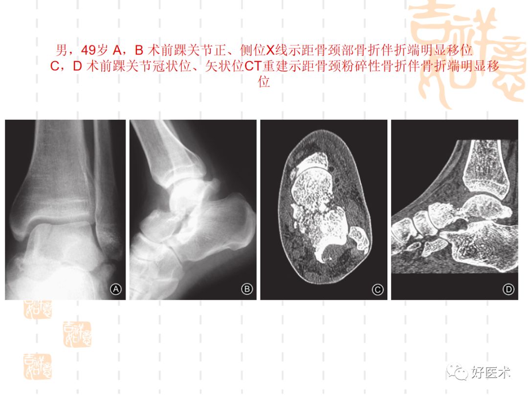 距骨骨折的手术入路及治疗技巧详解，值得一看！