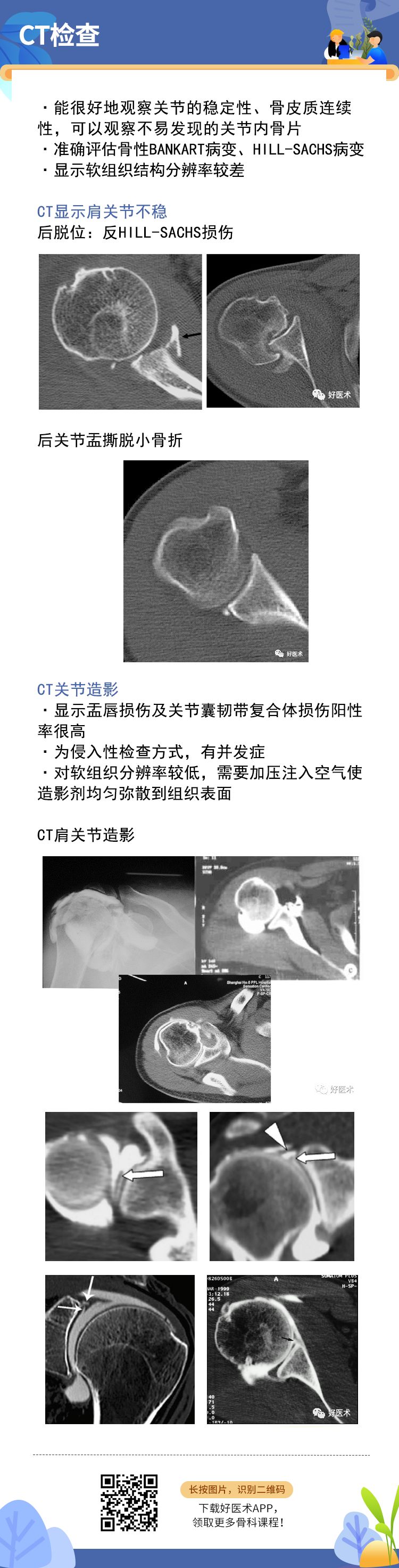 肩关节损伤的影像学诊断技巧，看这篇就够了！