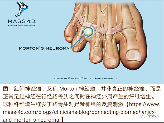 引起前足痛的Morton神经瘤，你了解吗？