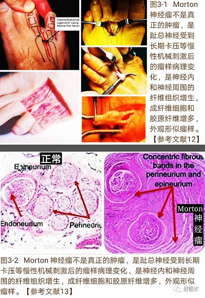 引起前足痛的Morton神经瘤，你了解吗？