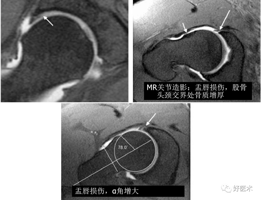 什么是“髋关节撞击综合征”？本文告诉你！