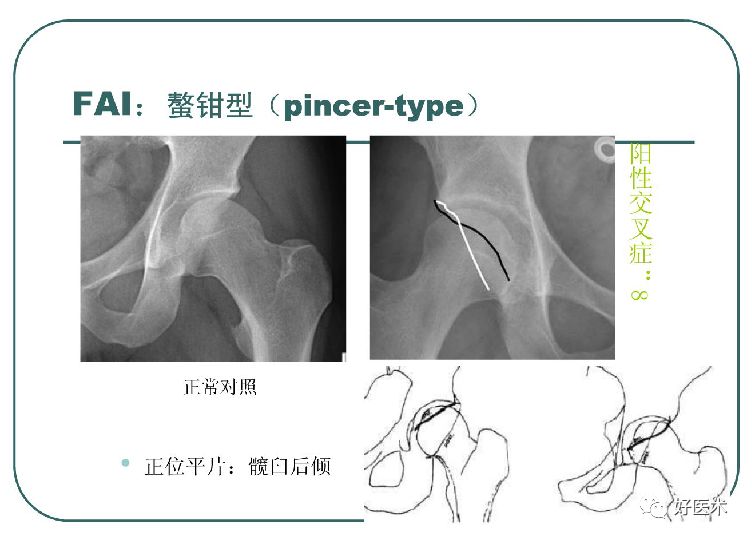 什么是“髋关节撞击综合征”？本文告诉你！